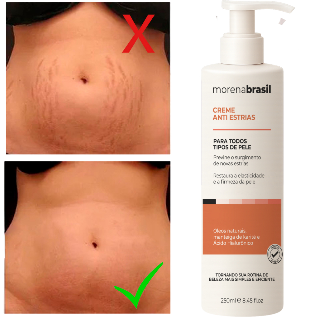 Review Creme Anti-Estrias - Diga Adeus às Estrias! Previne Novas Estrias & Reforça a Elasticidade Da Pele: Vale a Pena em 2026?